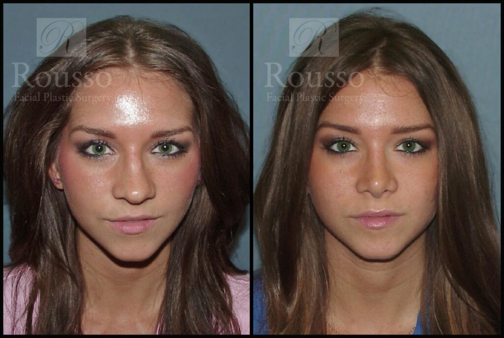 Rhinoplasty Cost Alabama