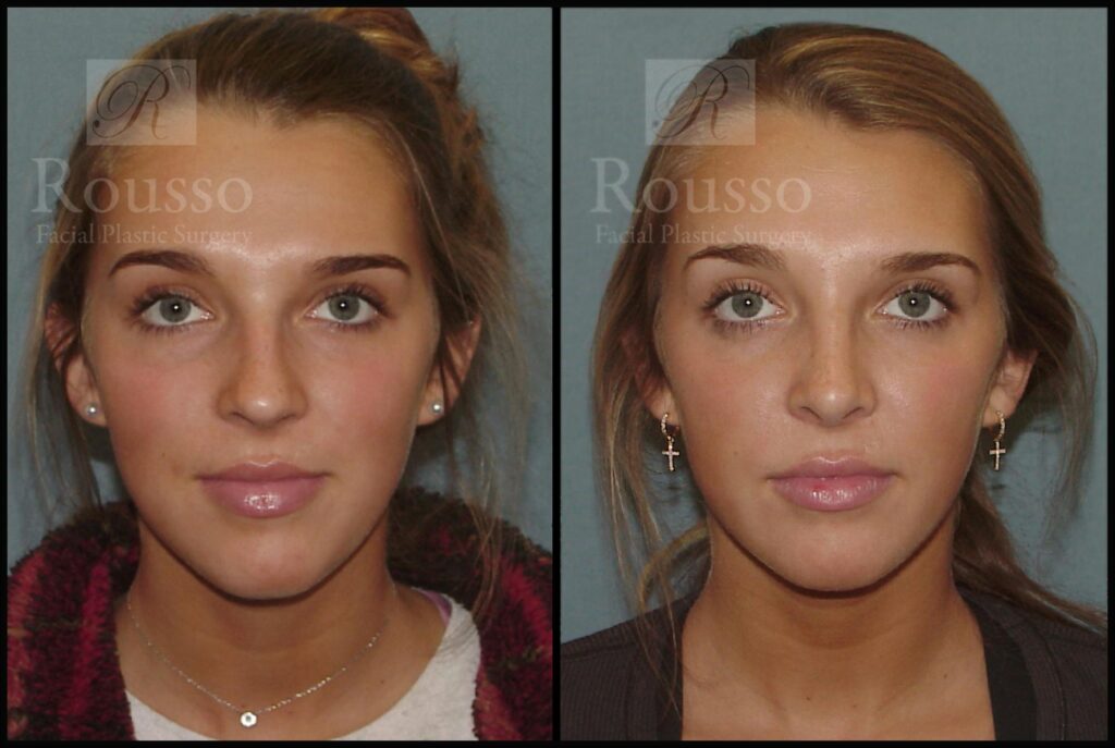 Rhinoplasty Cost Alabama