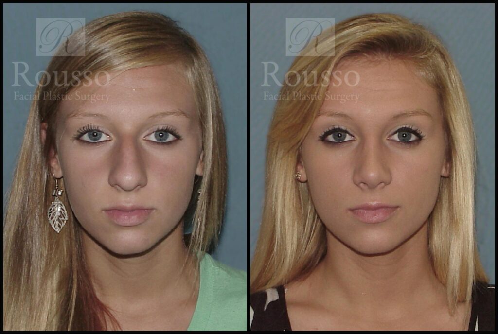 Rhinoplasty Cost Alabama