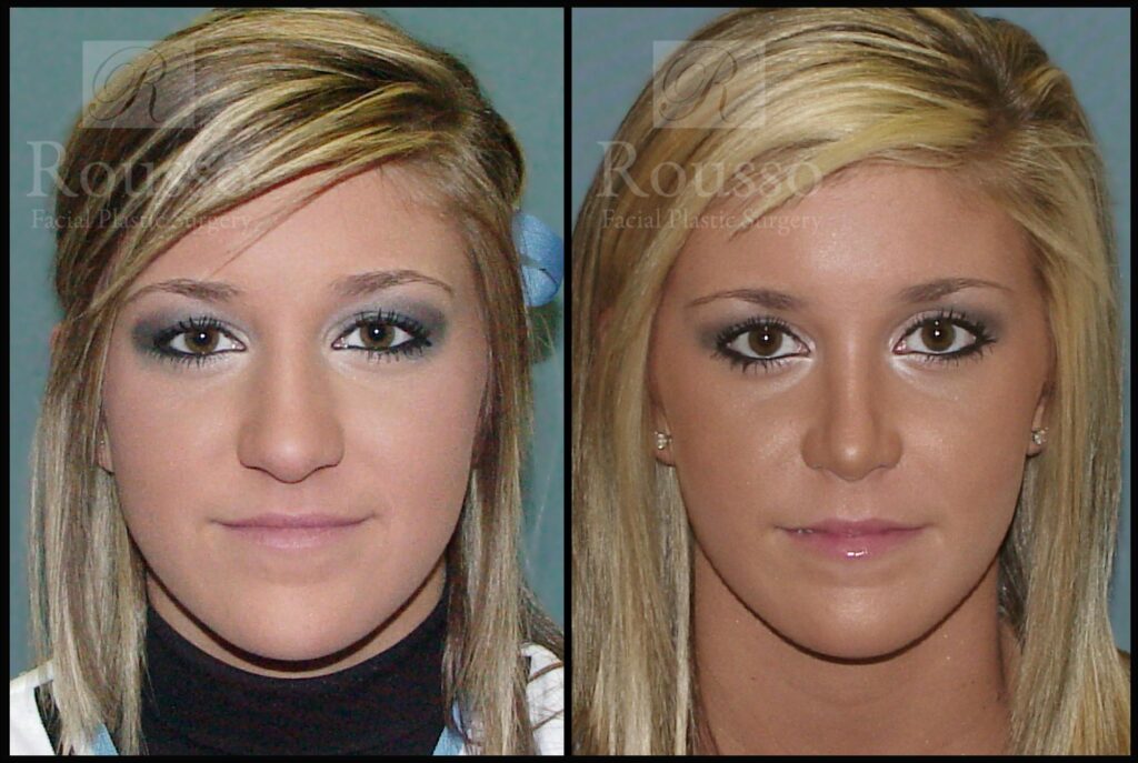 Rhinoplasty Cost Alabama