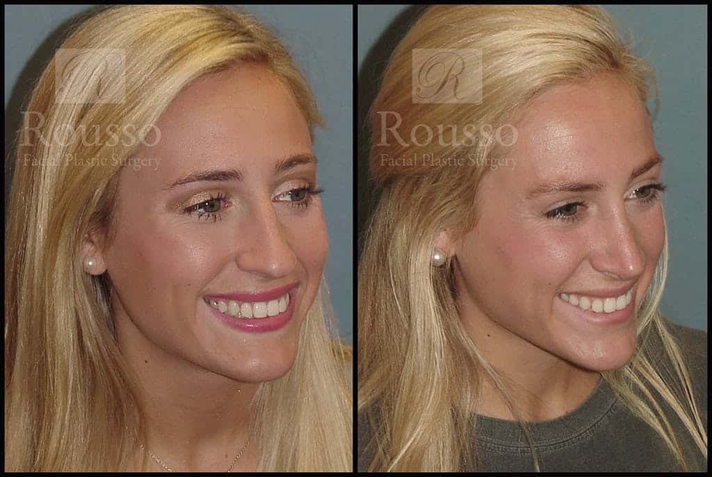 Rhinoplasty Cost Alabama