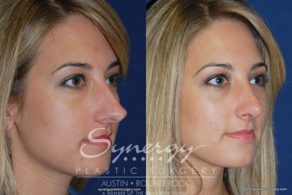 Rhinoplasty Cost Austin