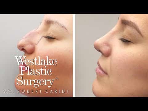 Rhinoplasty Cost Austin