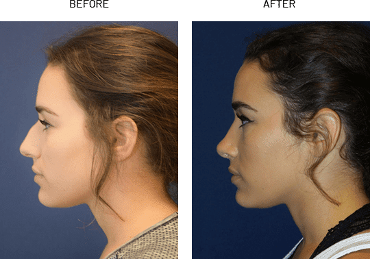 Rhinoplasty Cost Austin