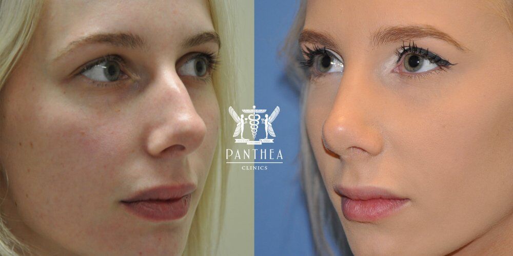Rhinoplasty Cost Australia