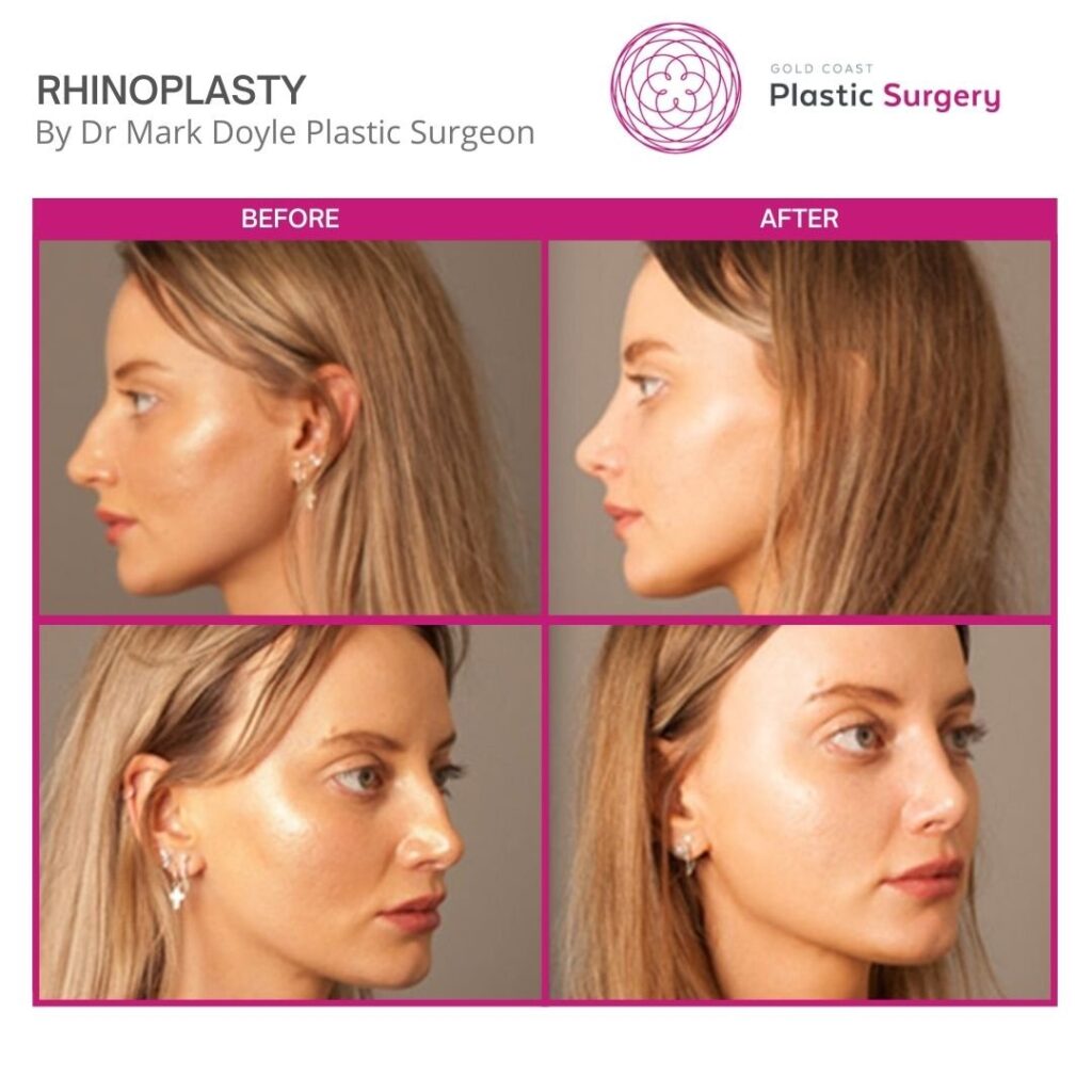 Rhinoplasty Cost Australia