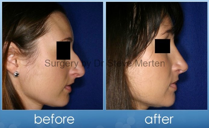 Rhinoplasty Cost Australia