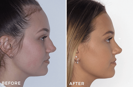 Rhinoplasty Cost Australia