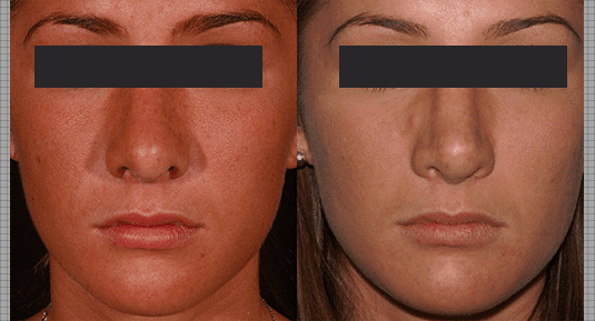 Rhinoplasty Cost Connecticut