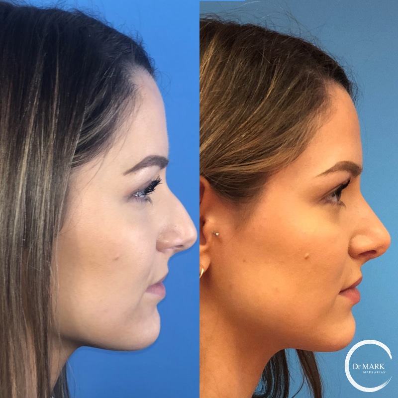 Rhinoplasty Cost Connecticut