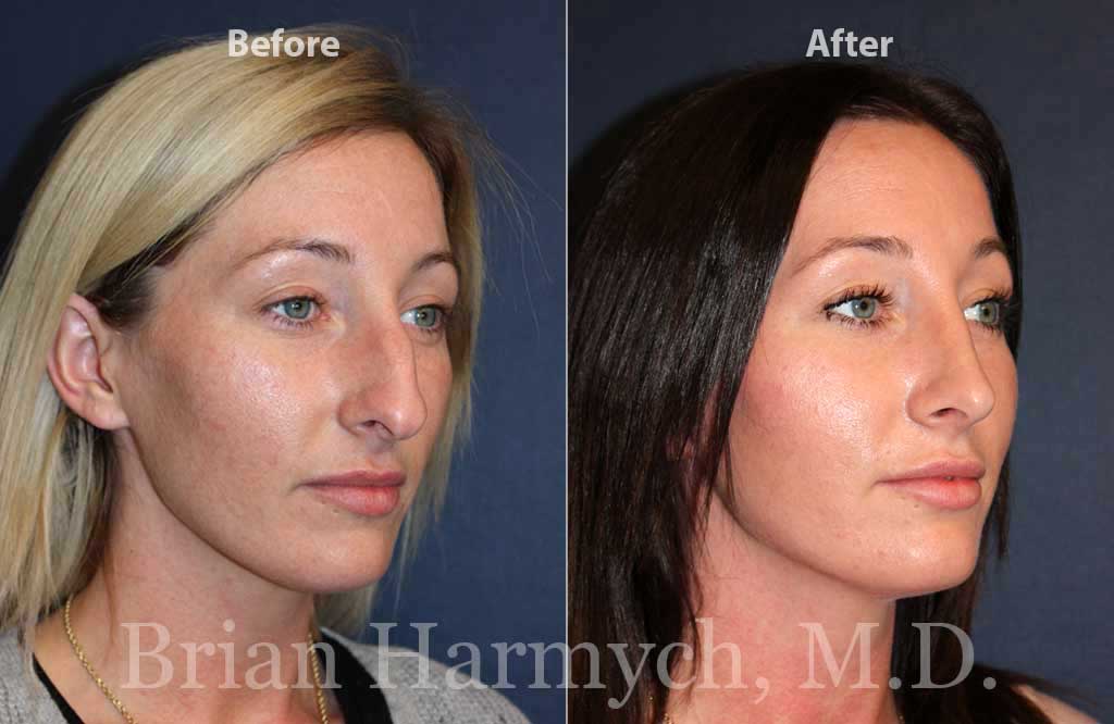 Rhinoplasty Cost Ohio