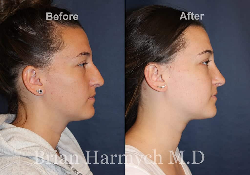 Rhinoplasty Cost Ohio