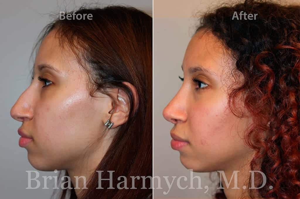 Rhinoplasty Cost Ohio