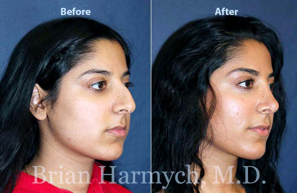 Rhinoplasty Cost Ohio