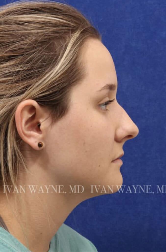 Rhinoplasty Cost Okc Rhinoplasty Cost Okc