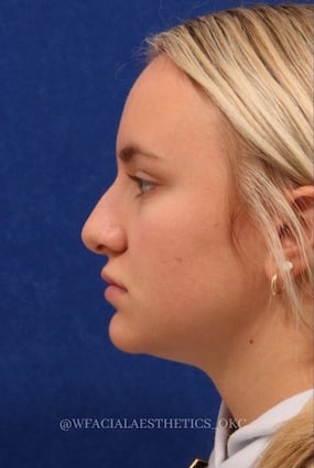 Rhinoplasty Cost Okc Rhinoplasty Cost Okc
