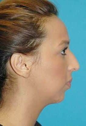Rhinoplasty Cost Okc Rhinoplasty Cost Okc