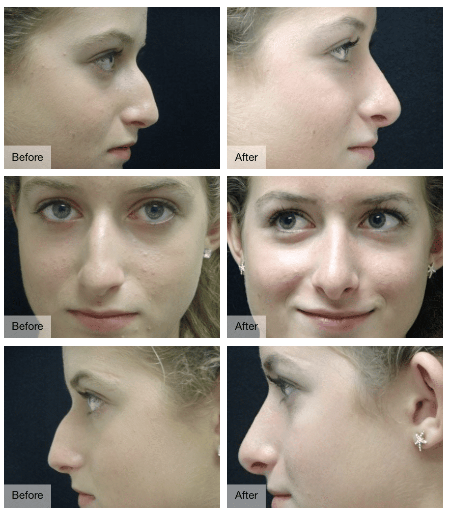 Rhinoplasty Cost Okc Rhinoplasty Cost Okc
