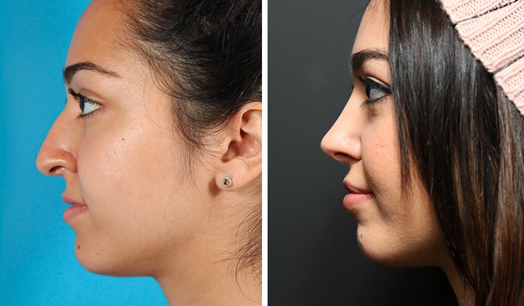 Rhinoplasty Cost Ontario Rhinoplasty Cost Ontario