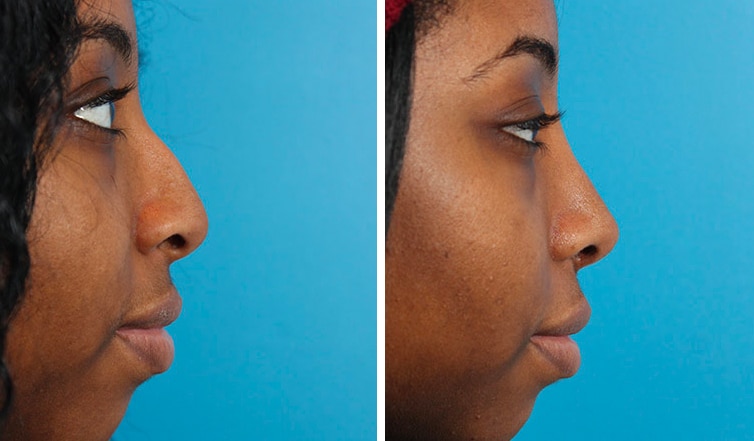 Rhinoplasty Cost Ontario Rhinoplasty Cost Ontario