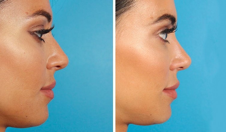 Rhinoplasty Cost Ontario Rhinoplasty Cost Ontario