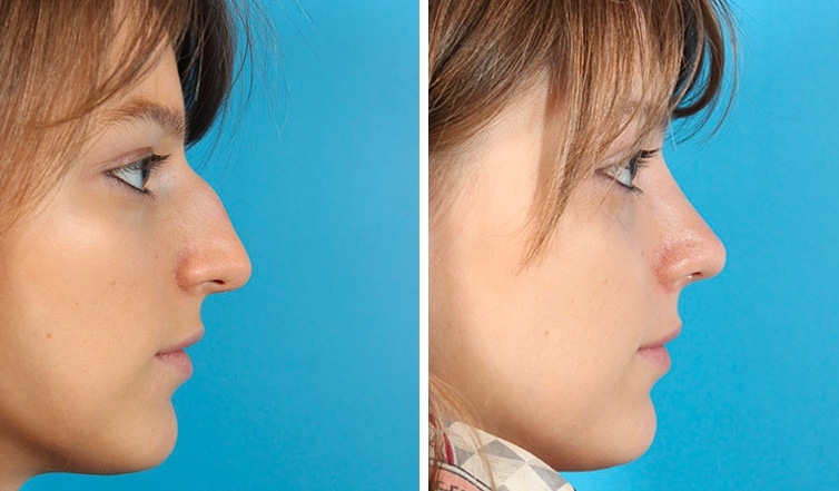 Rhinoplasty Cost Ontario Rhinoplasty Cost Ontario