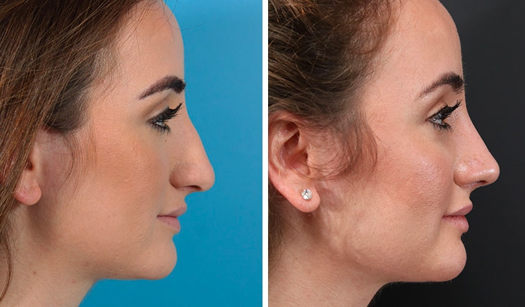 Rhinoplasty Cost Ontario Rhinoplasty Cost Ontario