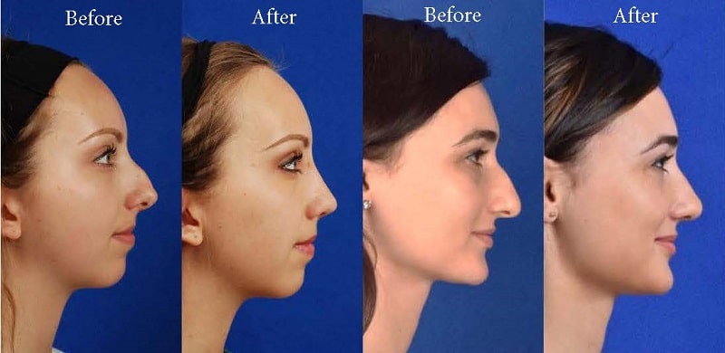 Rhinoplasty Cost Oregon