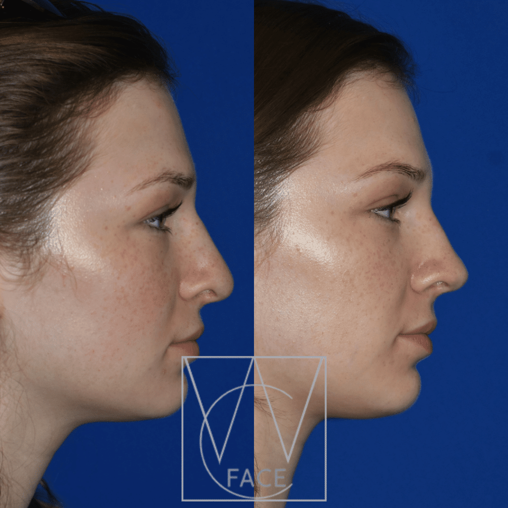 Rhinoplasty Cost Oregon