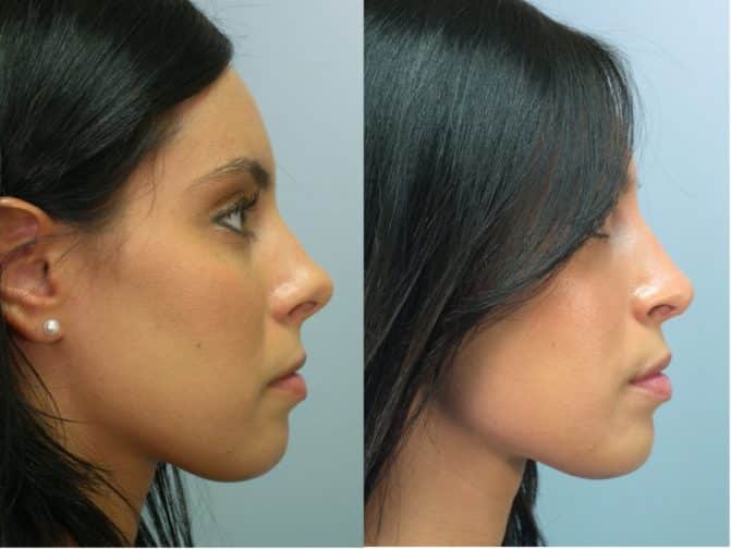 Rhinoplasty Cost Oregon