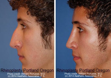 Rhinoplasty Cost Oregon