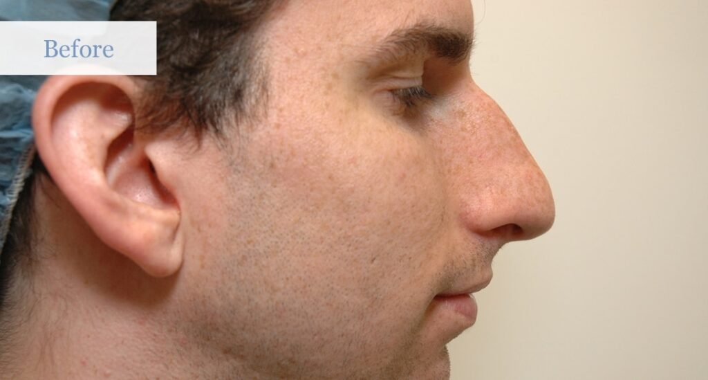 Rhinoplasty Cost Ottawa Rhinoplasty Cost Ottawa