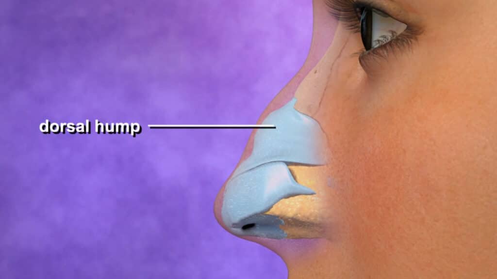 Rhinoplasty Cost Reno