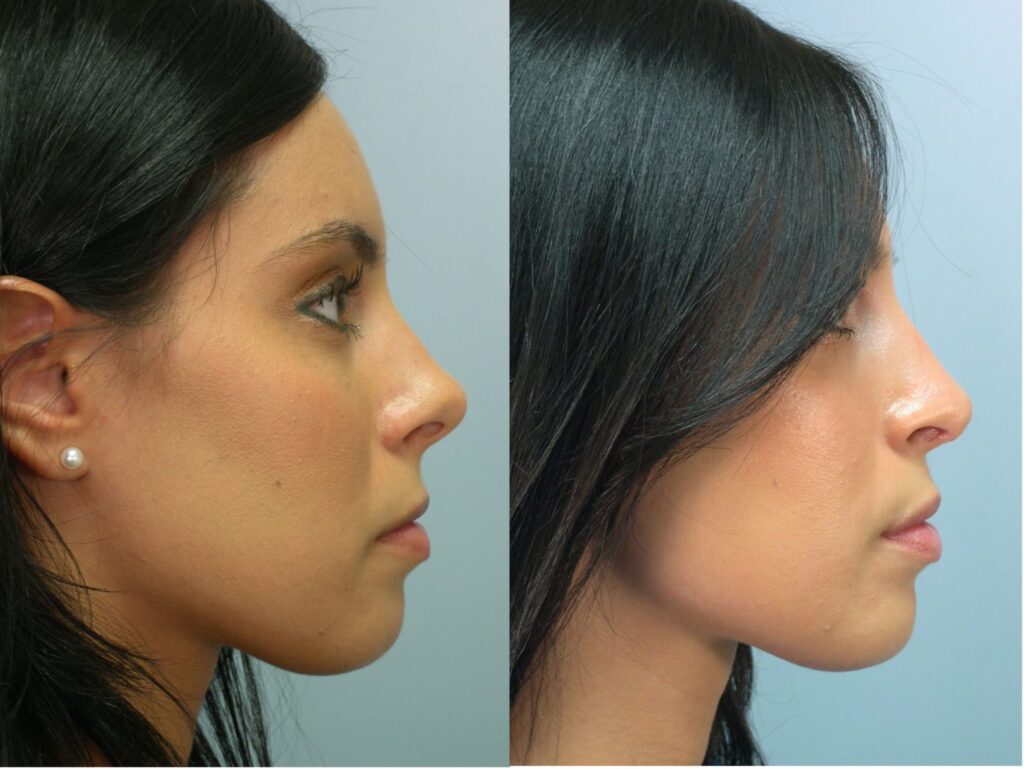 Rhinoplasty Cost Reno