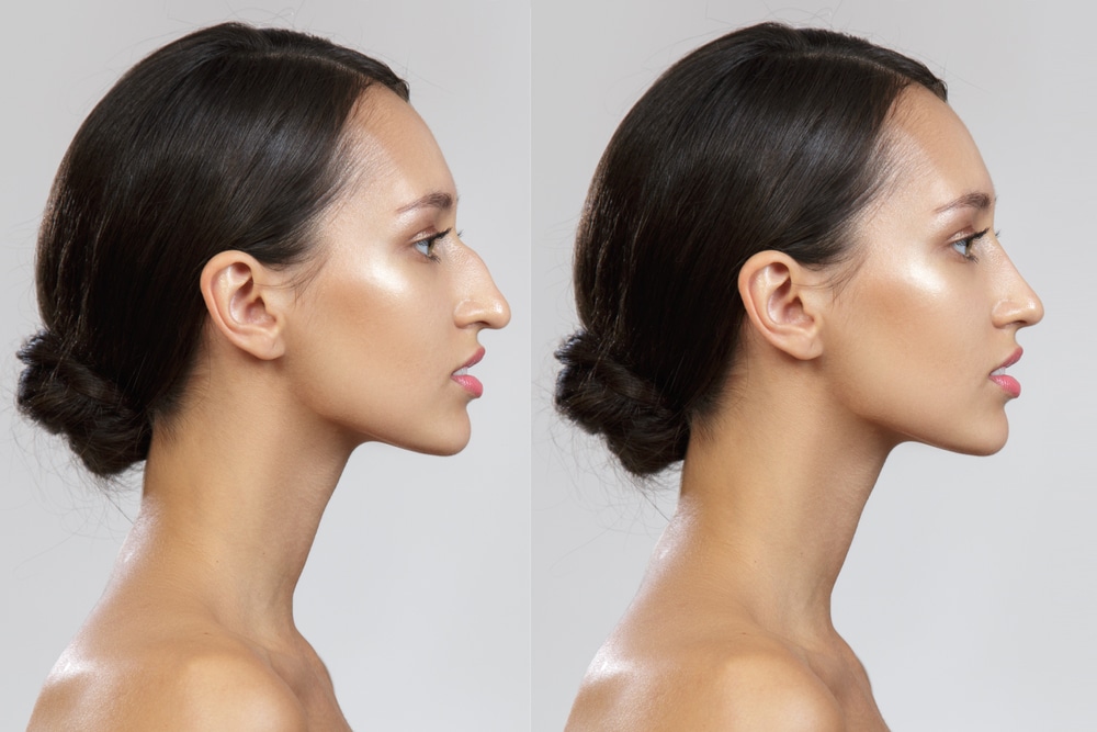Rhinoplasty Cost Richmond Va