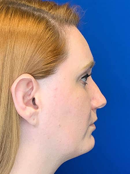Rhinoplasty Cost Richmond Va