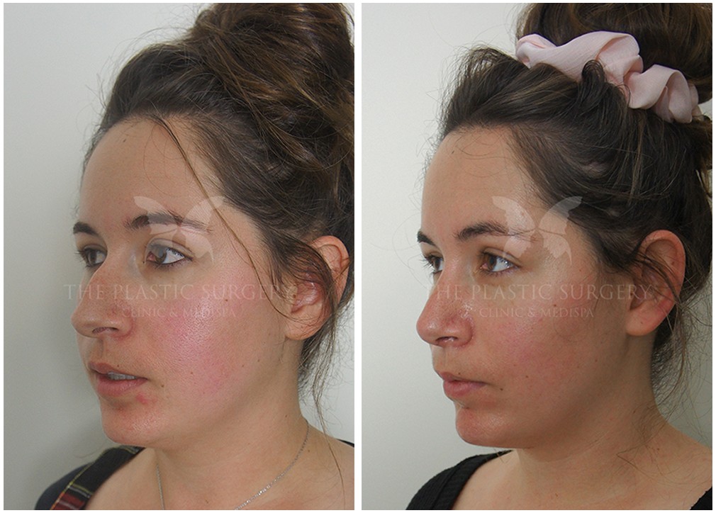 Rhinoplasty Cost Sydney Rhinoplasty Cost Sydney