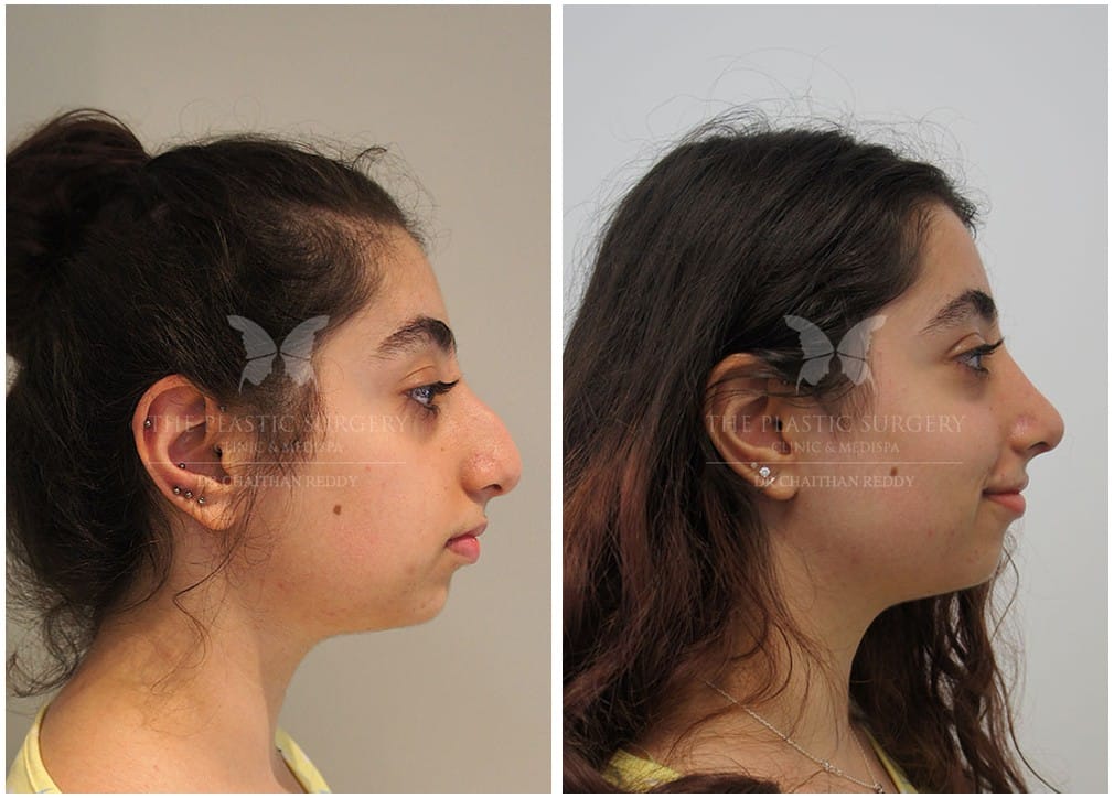 Rhinoplasty Cost Sydney Rhinoplasty Cost Sydney