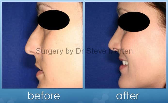 Rhinoplasty Cost Sydney Rhinoplasty Cost Sydney