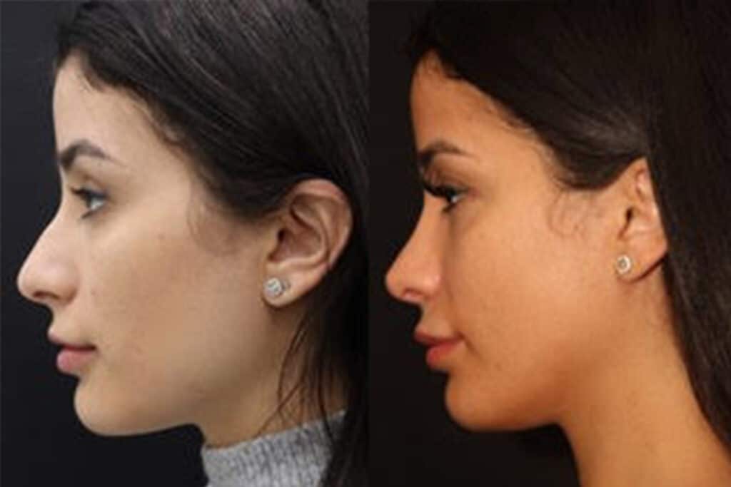 Rhinoplasty Cost Toronto