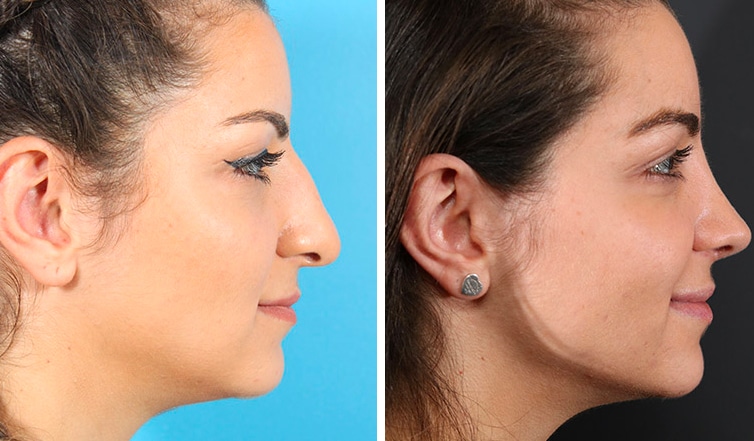 Rhinoplasty Cost Toronto